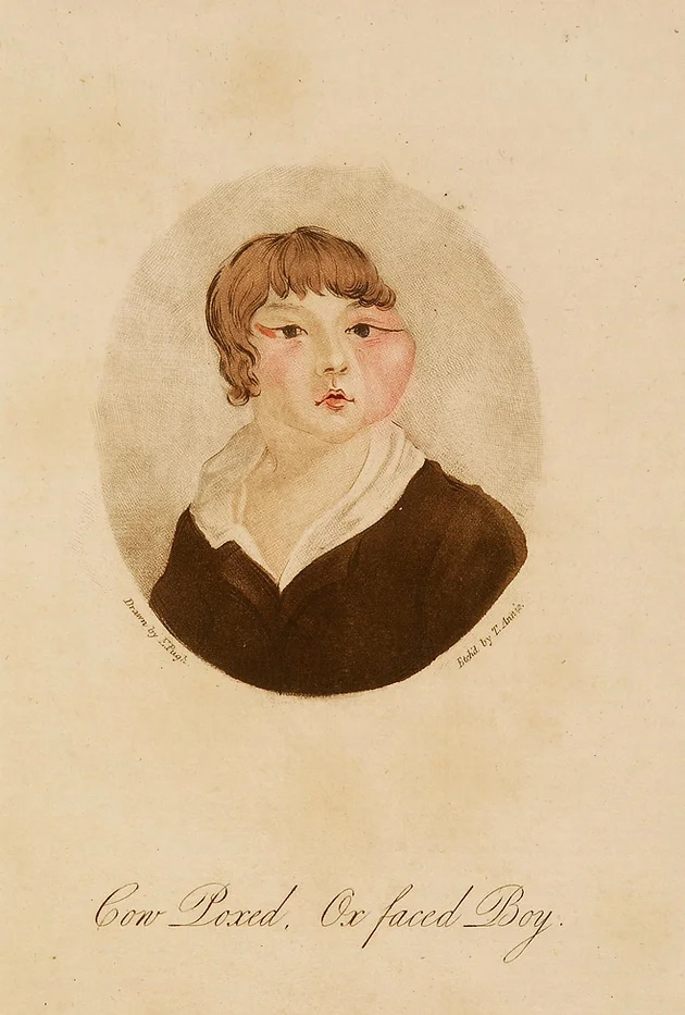 Drawing of a child with a large red swelling on the left cheek. 